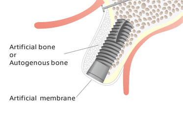 GBR (Guided Bone Regeneration) technique - Dental Implants Net